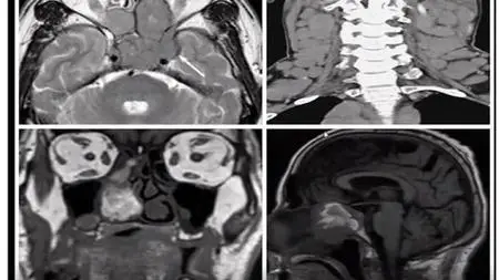 6 Sutton Central Nervous System FRCR Series