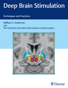 Deep Brain Stimulation : Techniques and Practices