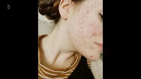 Acne In Search Of A Cure (2020)