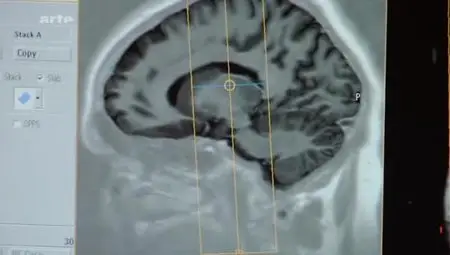 (Arte) Stimulation cérébrale, un nouvel espoir pour les T.O.C. (2012)
