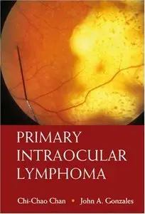 Primary Intraocular Lymphoma by John A Gonzales
