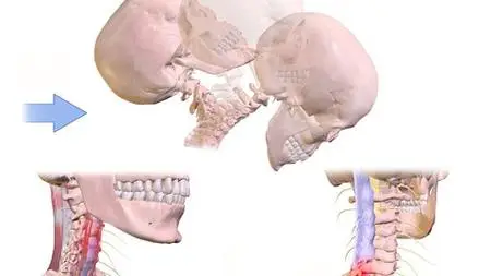 Physiotherapy Management Of Whiplash Injuries