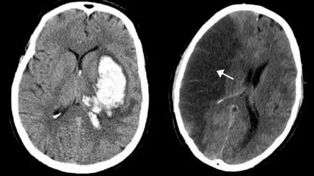 Brain Stroke - Impacts, Management, and Recovery