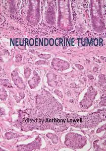 "Neuroendocrine Tumor" ed. by Anthony Lowell