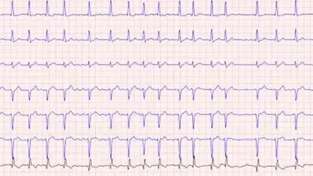 Palpitations & Chest Pain : Atrial Fibrillation : Scenario