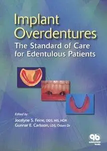 Implant Overdentures: The Standard of Care for Edentulous Patients (Repost)