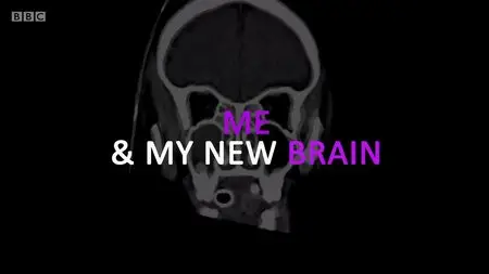 BBC - Me & My New Brain (2015)