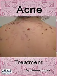 «Acne Treatment» by Owen Jones