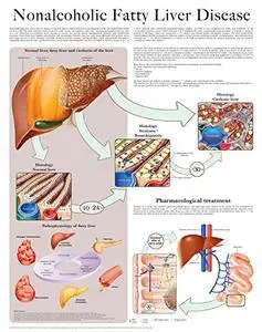 Nonalcoholic Fatty Liver Disease e chart: Full illustrated