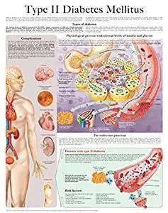 Type II Diabetes Mellitus e-chart: Full illustrated