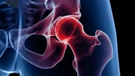 Hip Arthroscopy-Diagnosis, Complications And Rehabilitation