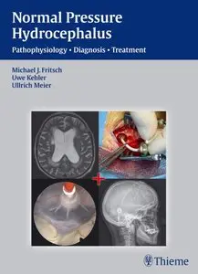 NPH - Normal Pressure Hydrocephalus: Pathophysiology - Diagnosis - Treatment (repost)