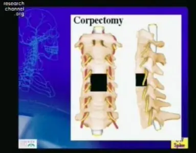 Video of "Advances in Anterior Cervical Spine Surgery" 2009