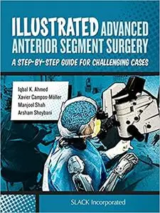 Illustrated Advanced Anterior Segment Surgery: A Step-by-Step Guide for Challenging Cases