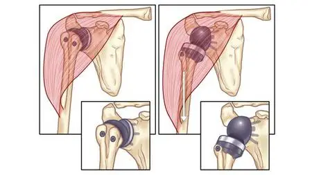 What To Expect After A Total Shoulder Replacement