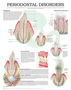 Periodontal disorders e chart: Full illustrated