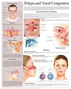 Polyps and Nasal Congestion e-chart: Full illustrated