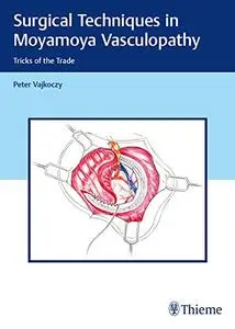 Surgical Techniques in Moyamoya Vasculopathy: Tricks of the Trade