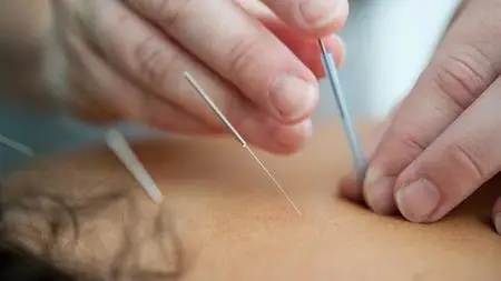 Dry Needling The Shoulder.