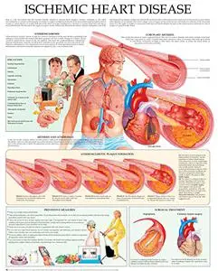 Ischemic heart disease e-chart: Quick reference guide