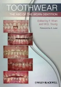 Toothwear: The ABC of the Worn Dentition