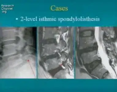 Video of "Indications for Lumbar Fusions" 2009