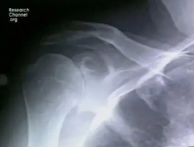 Video of "Total Shoulder Replacement: Partnership with the Patient" 2009