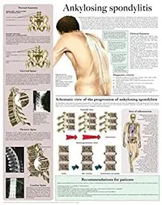 Ankylosing spondylitis e-chart: Quick reference guide