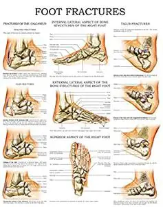 Foot fractures - Quick Reference Chart: Full illustrated