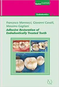 Adhesive Restoration of Endodontically Treated Teeth: Endodontics 4