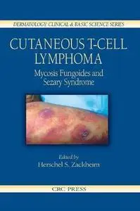 Cutaneous T-Cell Lymphoma: Mycosis Fungoides and Sezary Syndrome