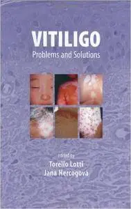 Vitiligo: Problems and Solutions