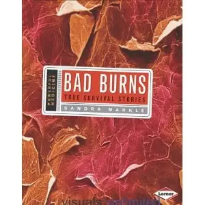 Bad Burns: True Survival Stories