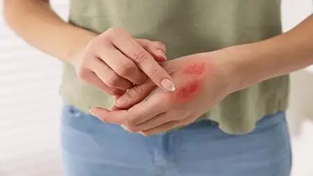 Beyond the Burn: Comprehensive Burn Care Strategies