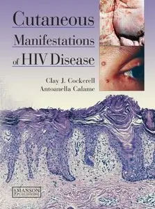 Cutaneous Manifestations of HIV Disease (repost)
