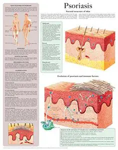 Psoriasis e-chart: Full illustrated