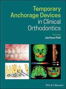 Temporary Anchorage Devices in Clinical Orthodontics (Repost)