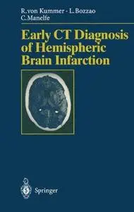 Early CT Diagnosis of Hemispheric Brain Infarction