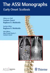 The ASSI Monographs Early Onset Scoliosis